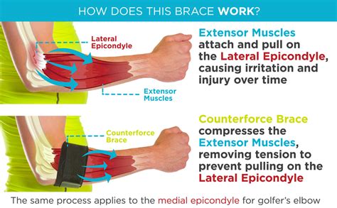 Tendonitis Counterforce Brace | Tennis & Golfers Elbow Support Strap