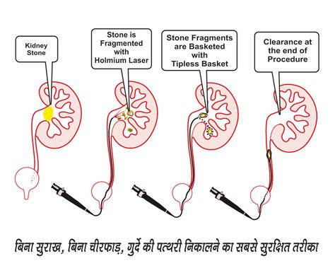 kidney-stone-treatment