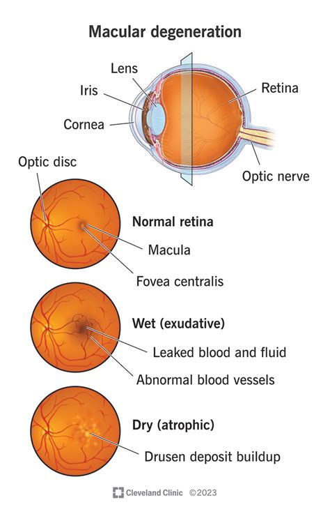 Macular Degeneration: Symptoms, Diagnosis & Treatment