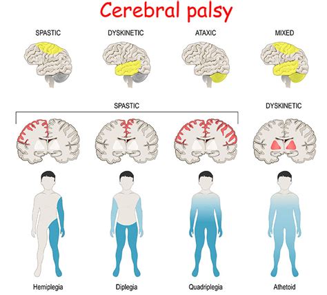 Types Of Cerebral Palsy Brain