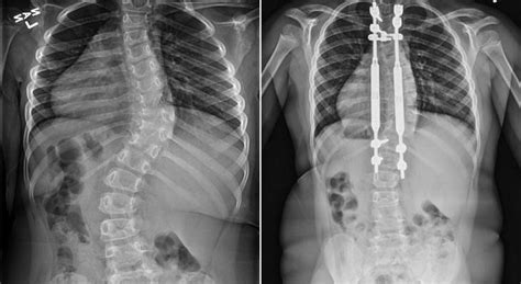 Scoliosis Surgery Before And After X Ray