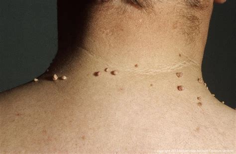 SKIN TAGS AND SKIN GROWTHS: Essence Medispa: Cosmetic Dermatology