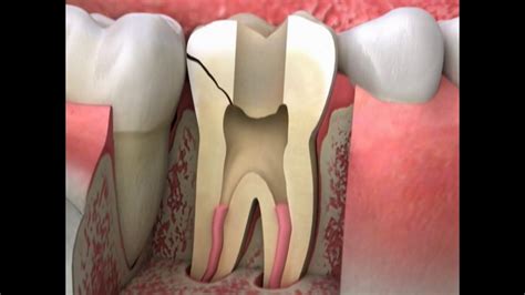 Cracked Tooth causes and Treatments - Cosmetic Dentists in Lancashire