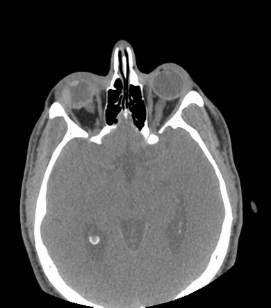 Globe rupture | Radiology Case | Radiopaedia.org