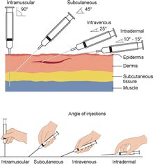 Intravenous therapy - Wikipedia