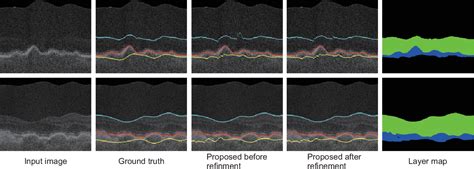 Figure 3 from Retinal Layer Segmentation from Oct Images Using 2D-3D Hybrid Network with Multi ...