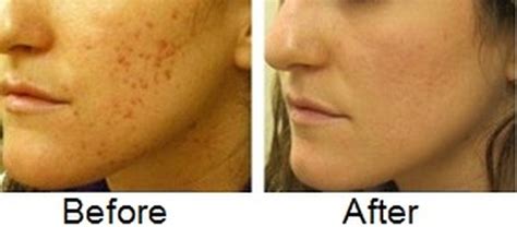 How to Fade Acne Scars Fast, Naturally, Diminish Acne Marks, Permanently at home