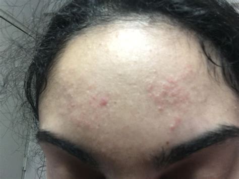 Forehead rash or acne? - General acne discussion - Acne.org