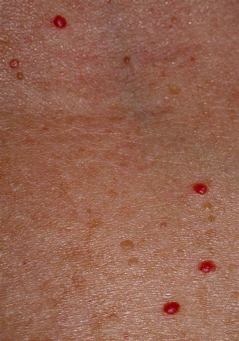 Cherry Angiomas Associated with Bromine Toxicity and Iodine Deficiency - A Man on Medicine