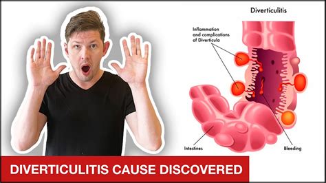 The ULTIMATE Diverticulitis Treatment Plan | 4 Simple Steps - YouTube