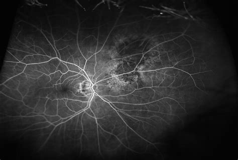 Choroidal Nevus[003] - Retina Image Bank