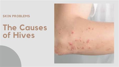 Must Know, 5 Causes Of Hives That Are Rarely Realized » 2023