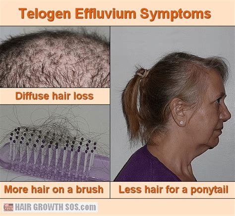 Chronic Telogen Effluvium - Symptoms, Causes, Treatment