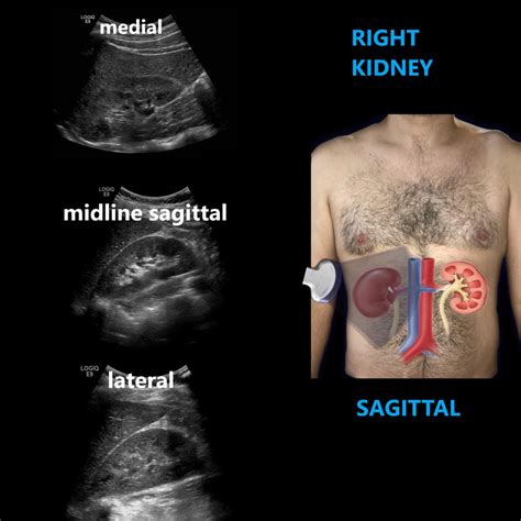 Renal Ultrasound Anatomy