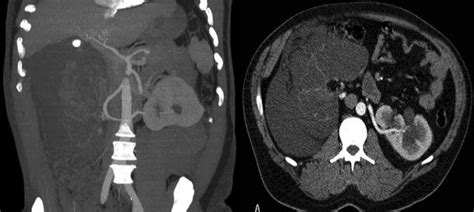 CT scan of the preoperative anatomy with the heavily insured right... | Download Scientific Diagram