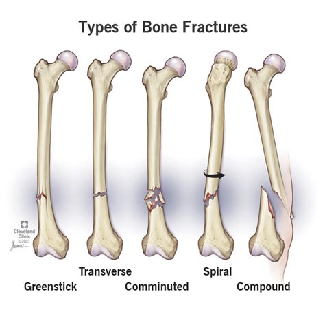 Factors Affecting Fracture Healing Basic Science OrthoFixar, 51% OFF