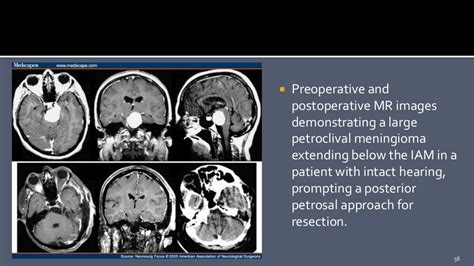 Petroclival Meningioma