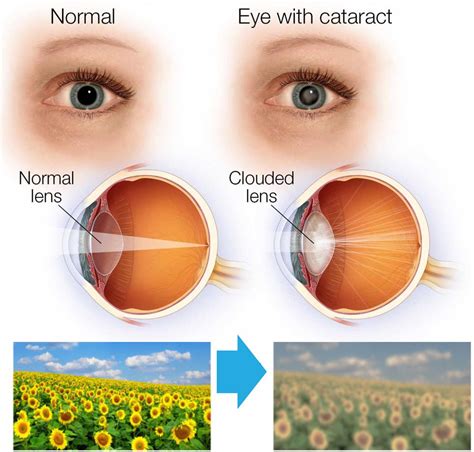 Cataract Surgery FAQs - Frequently Asked Questions - FW Eye Associates