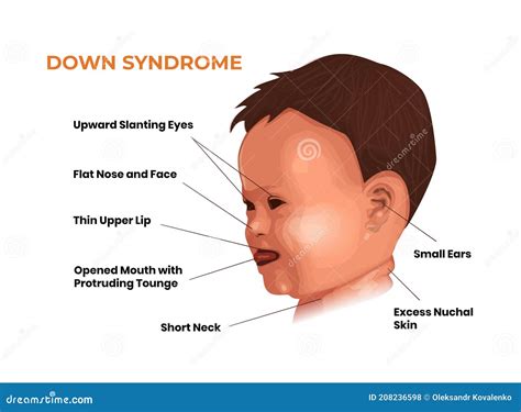 Trisomy Cartoons, Illustrations & Vector Stock Images - 143 Pictures to ...