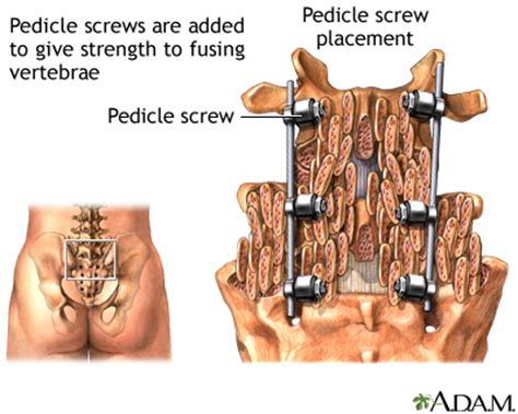 Spinal fusion - series—Pedicle screw: MedlinePlus Medical Encyclopedia