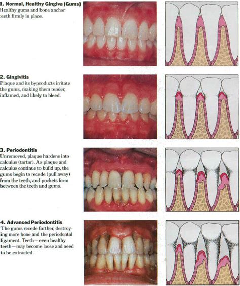 Gum Disease | Dr Jude St George