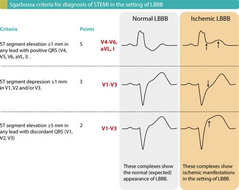 STEMI (ST Elevation Myocardial Infarction): diagnosis, criteria, ECG & management ...