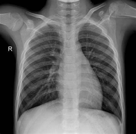 (a) and (b) are the PA view of the chest X-rays of COVID-19 positive... | Download Scientific ...