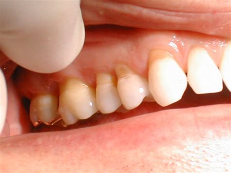 Tooth Abrasion & Tooth Erosion - Lemesos Dental Clinic Ltd