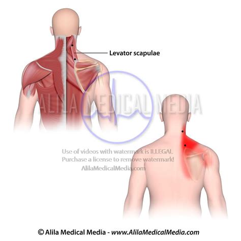 Levator Scapulae Trigger Points