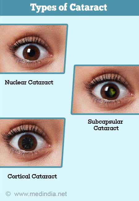 Cortical Cataract