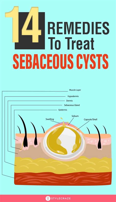 How To Prevent Sebaceous Cysts - Sonmixture11