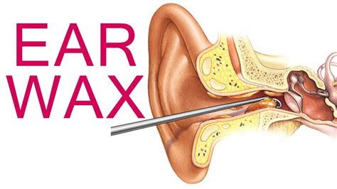 Ear Wax Blockage - Causes, Symptoms, How to Remove Ear Wax