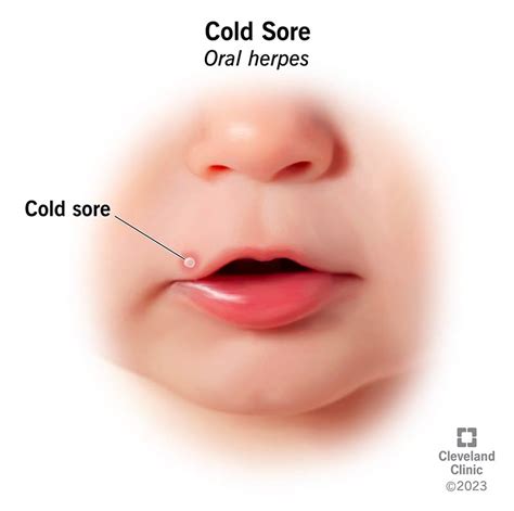 Cold Sore On Lower Lip