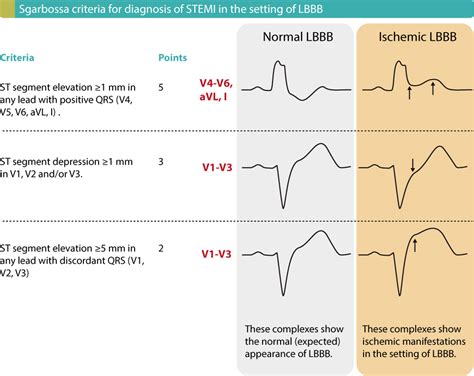 STEMI (ST Elevation Myocardial Infarction): diagnosis, criteria, ECG & management – ECG learning