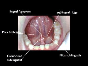 Sublingual Sulcus