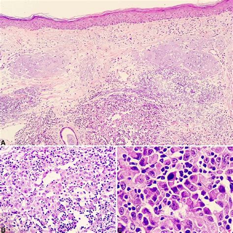 Histopathological characteristics of the neoplasm. A: small... | Download Scientific Diagram