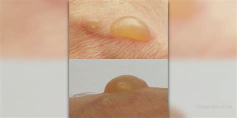 Sun poisoning blisters | Skin & Hair problems articles | Body & Health Conditions center ...