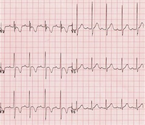 T wave • LITFL • ECG Library Basics