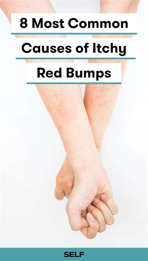 10 Common Causes of Itchy, Red Bumps and Skin Rashes | Severe itchy skin, Itchy red bumps ...