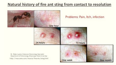 Fire ant stings: pathophysiology and natural remedy