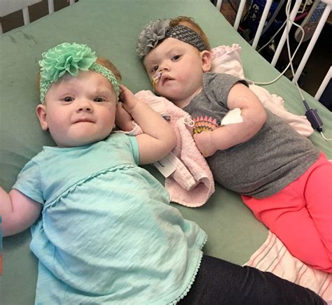 5 Months After Life Changing Surgery, Former Conjoined Twins Are Finally On Their Way Home