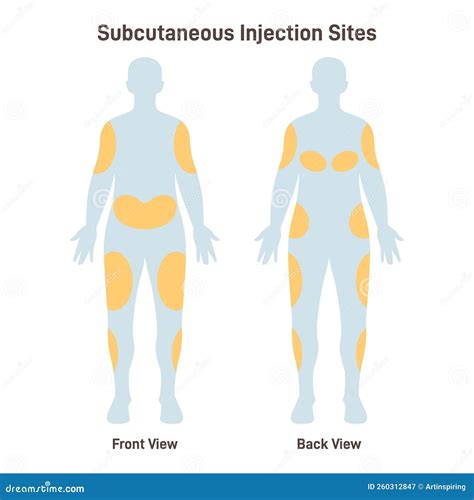 Subcutaneous Injection Sites. Medicine Injection Sites On The Human Body Cartoon Vector ...