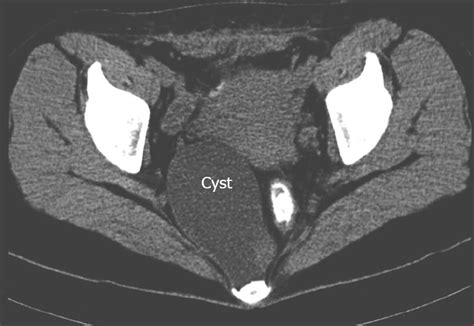 Perirectal Cyst