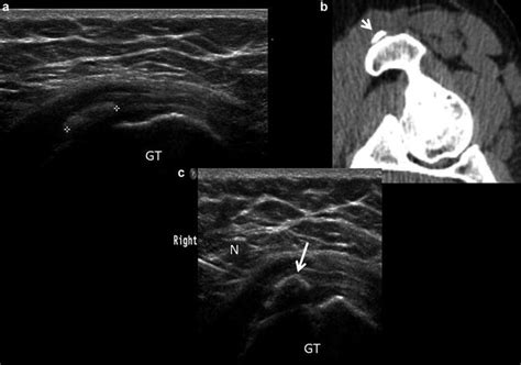 Ultrasound of the Hip | Musculoskeletal Key