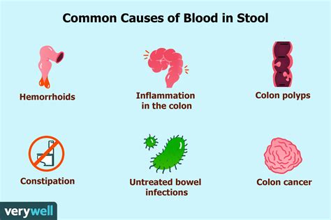 What Causes Bloody Mucus Stools | Images and Photos finder