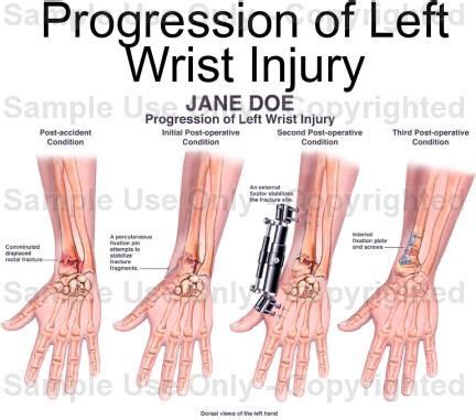 17+ images about Wrist Injury on Pinterest | Greater toronto area, Pain d'epices and Racquet sports