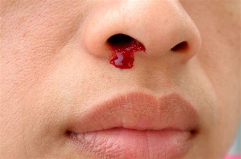 a young boy with a nosebleed | Nose bleeds, Sinus allergies, Stop nose ...