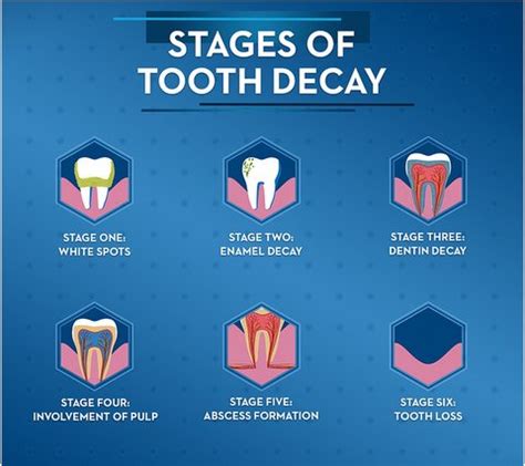 Understanding the Five Stages of Tooth Decay - Plum Grove Dental Center, Palatine, Illinois