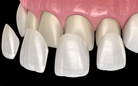 Dental veneers - Types, Uses & Process - Safar Medical