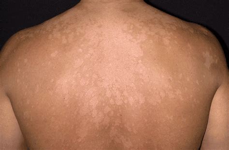 Medical SKIN Care: TINEA VERSICOLOR ( SKIN FUNGUS)